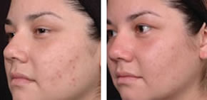 Acne before and after 1