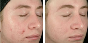 Acne before and after 2
