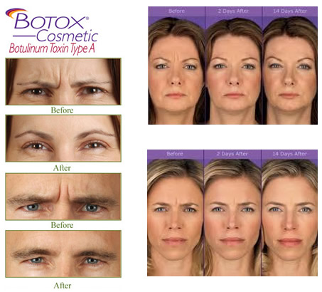 BOTOX Before and After