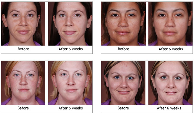 Obagi-C® Rx System before and afters