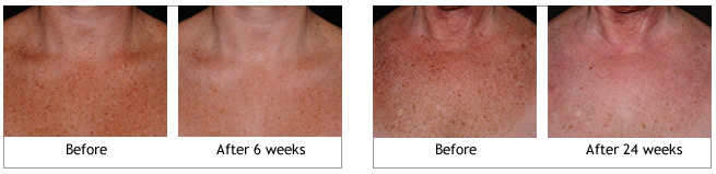 Obagi ELASTIderm Decolletage System before and afters