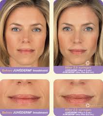 Filler before and after 3