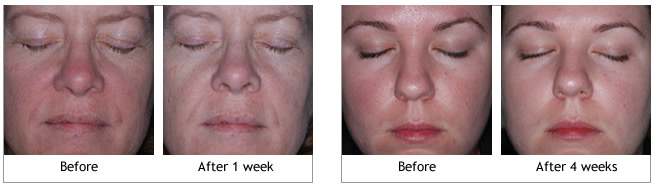 Obagi Rosaclear System before and afters