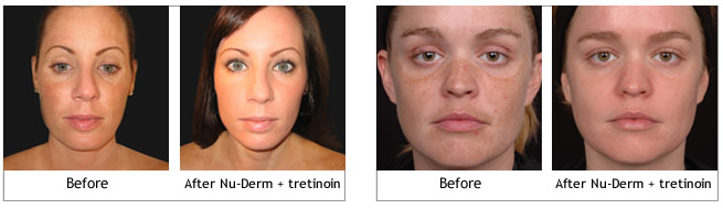Obagi Nu-Derm Systems before and afters